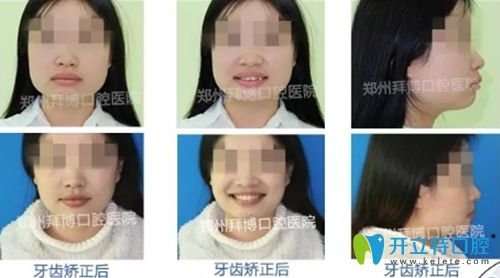 郑州拜博口腔提供的成人牙齿矫正前后效果图