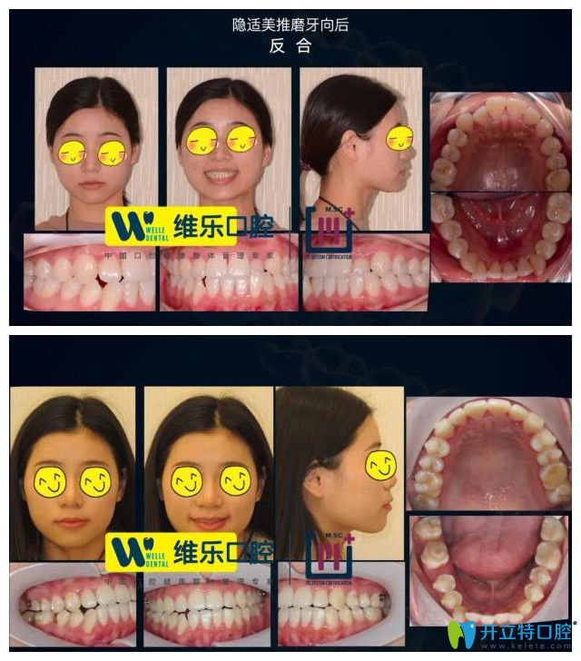 维尔口腔反颌导致牙缝增大案例图