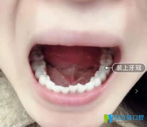 我在<!--<i data=20240703-sp></i>-->亿大口腔做种植牙效果