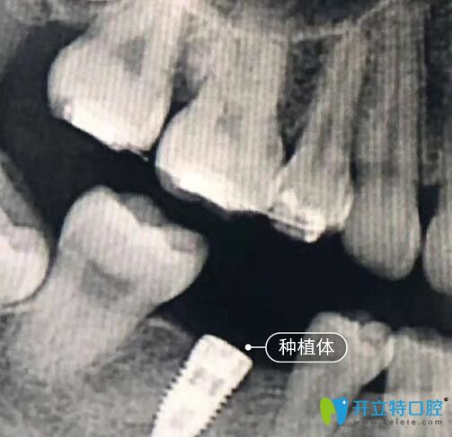 我在上海亿大口腔做种植牙CT片