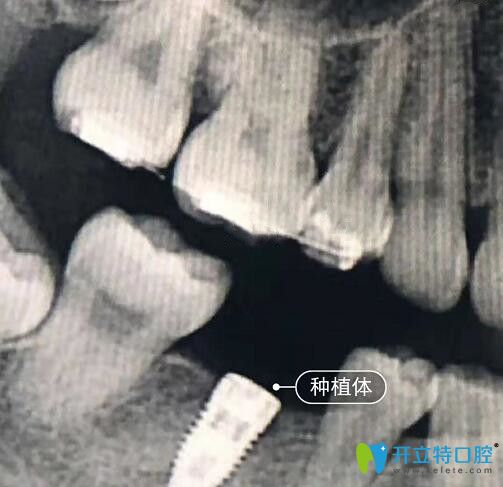 我在<!--<i data=20240703-sp></i>-->亿大口腔做种植牙CT片