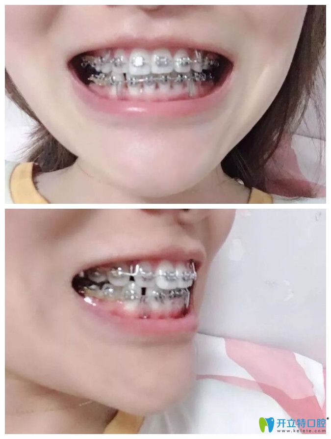 牙齿矫正戴橡皮筋收缝阶段图