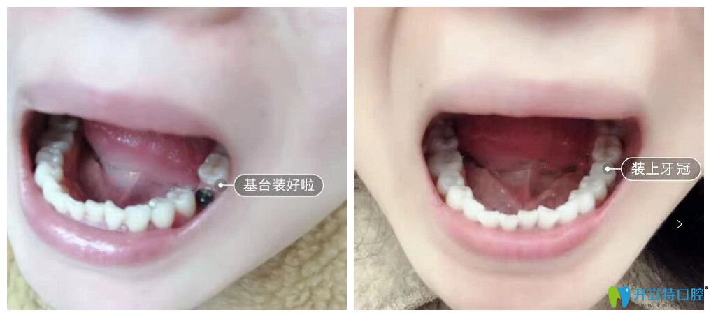 广州圣贝口腔单颗种植牙案例
