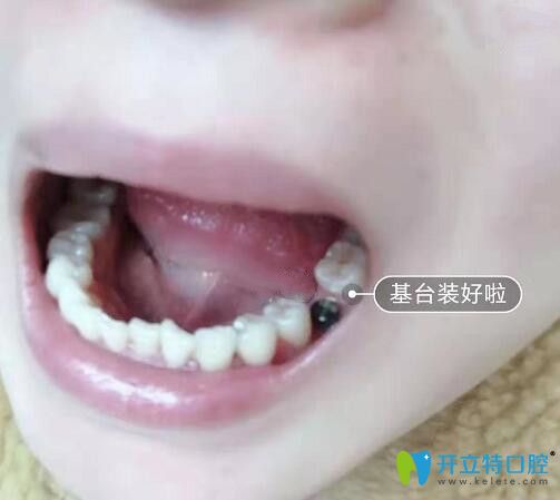 <!--<i data=20240703-sp></i>-->亿大口腔张睿医生给我做种植牙