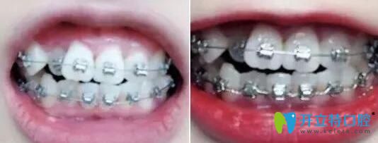 在珠海仁爱口腔做牙齿矫正第3和第4个月