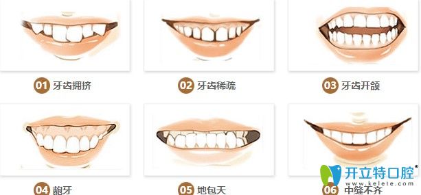 牙齿各类情况图示