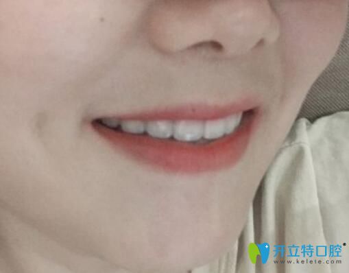 龅牙妹在郑州拜博口腔做牙齿矫正3年效果