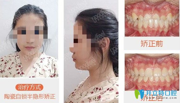 深圳格伦菲尔口腔牙齿矫正图