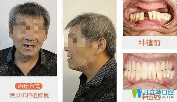 格伦菲尔口腔种植牙图