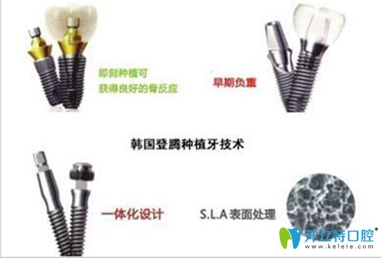 登腾种植牙价格合理效果不错 登腾种植牙价格合理效果不错