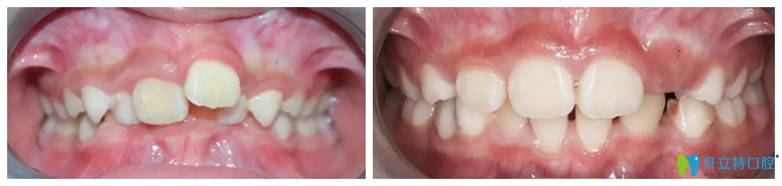 超龙牙博士口腔儿童深覆合矫正案例图