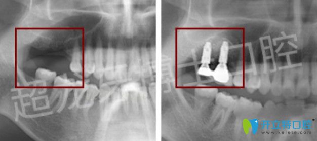 长春超龙牙博士口腔多颗牙种植案例图