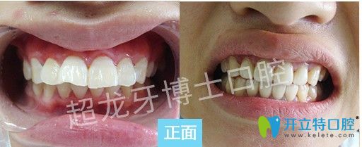 超龙牙博士口腔龅牙矫正案例图
