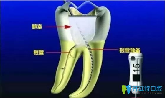 牙齿根管治疗科普图