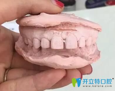 在深圳弘和口腔做隐适美牙齿矫正2年,圆了牙齿稀疏变齐梦