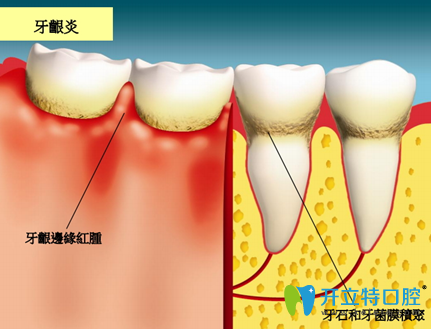 上海亿大口腔刘俊琨医生介绍牙龈炎的治疗方法