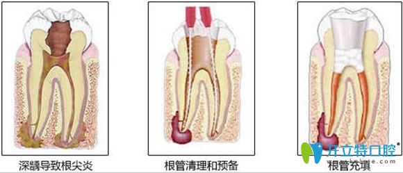 显微根管治疗5000多元!谁能告诉我牙齿根管治疗为什么那么贵