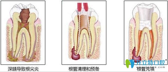 显微根管治疗5000多元!谁能告诉我牙齿根管治疗为什么那么贵