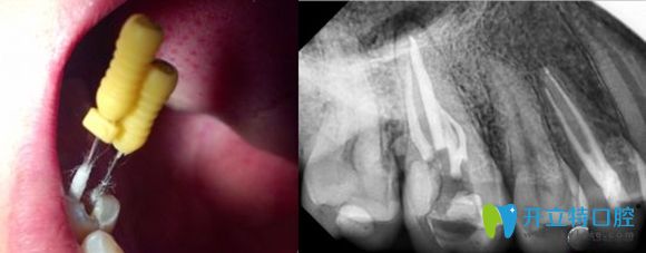 根管治疗后的X线片影像图