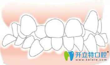 上海亿大口腔赵莹介绍儿童牙齿矫正在替牙期比较好