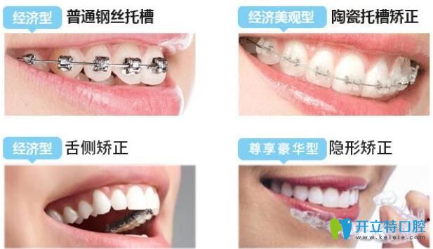 牙套类型影响牙套佩戴时间