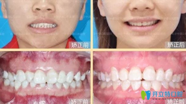 中诺口腔前牙深覆盖案例图 中诺口腔前牙深覆盖案例图