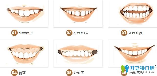 哪些牙齿需要做矫正图示