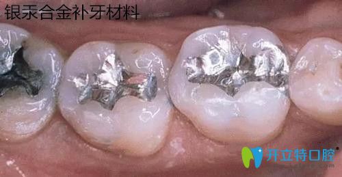 银汞合金补牙材料