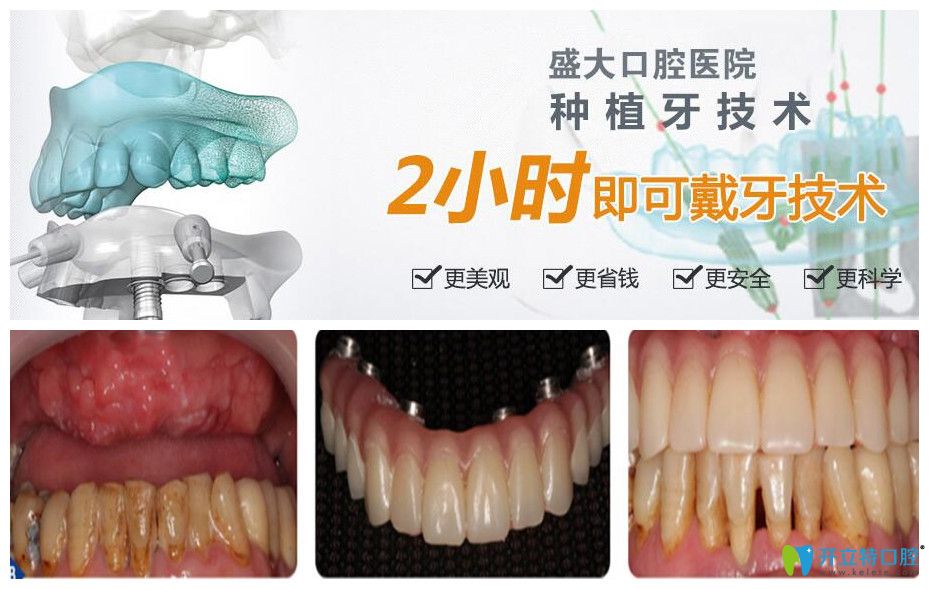 盛大口腔半口牙种植案例