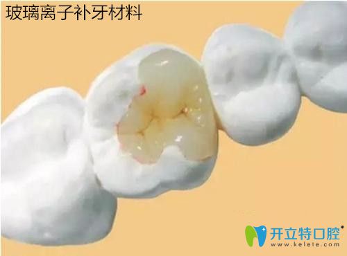 玻璃离子补牙材料