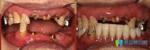 广州广大口腔半口牙种植案例图
