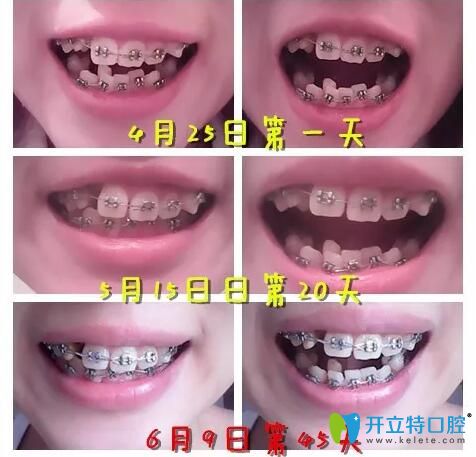 我牙齿拥挤在北京中诺口腔做牙齿矫正过程