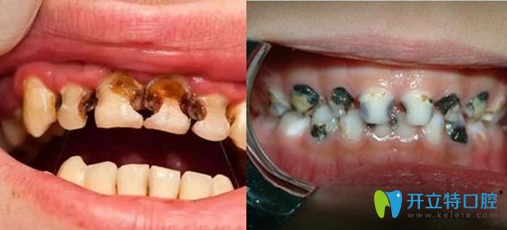 儿童龋齿蛀牙影响咀嚼及美观