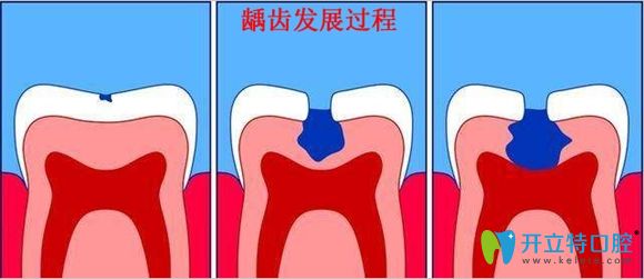 儿童龋齿一定要及时治疗