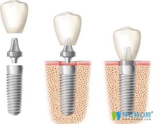 种植牙修复