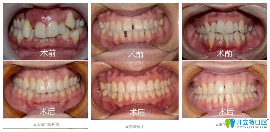 宁波恒美口腔做矫正怎么样？矫正价格不贵技术好