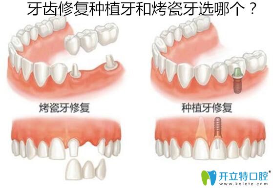 牙齿修复种植牙和烤瓷牙选哪个好