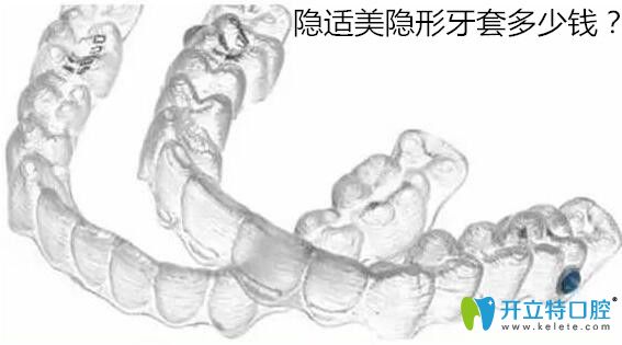 想了解隐适美矫正价格2万5贵不?先看invisalign隐形牙套多少钱