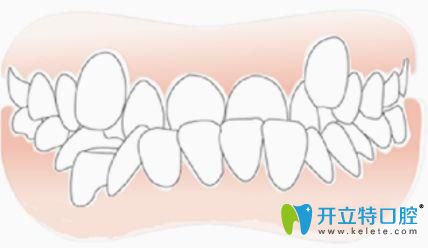 牙齿排列不齐错颌畸形引起颞下颌关节紊乱