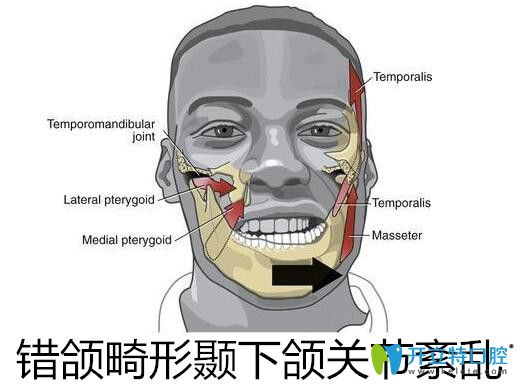 错颌畸形颞下颌关节紊乱矫正治疗