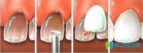 牙齿贴面修复过程图解