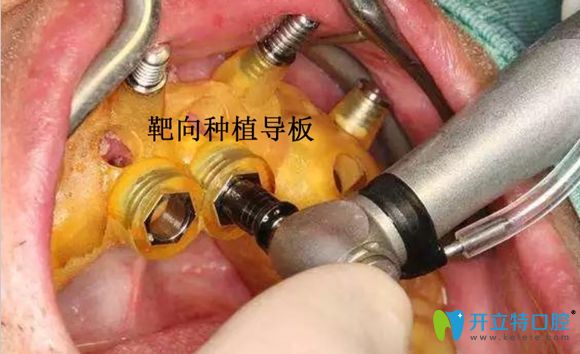 南京博韵口腔种植导板术中使用图