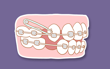 牙齿矫正中的疼痛感只是暂时的也是正常的
