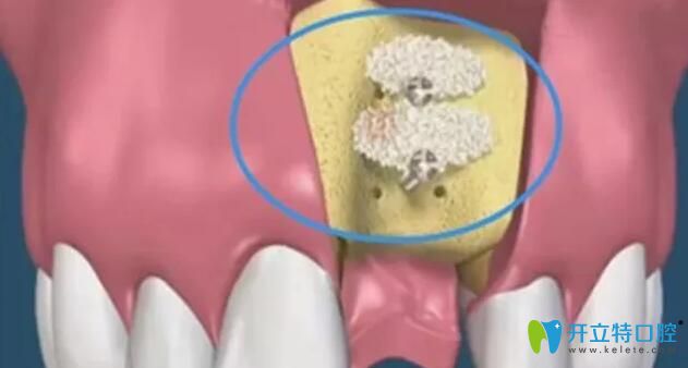 做种植牙被告知要植骨是被忽悠了吗?不植骨种牙会怎么样