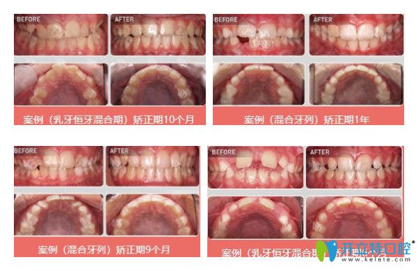 维乐口腔儿童牙齿矫正案例图示