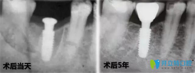 法国安卓健种植牙稳定性强 法国安卓健种植牙稳定性强