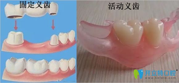 固定义齿和活动义齿修复缺牙示意图