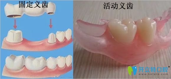 固定义齿和活动义齿修复缺牙示意图