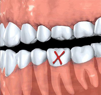 缺牙部分临牙的移动松动示意图