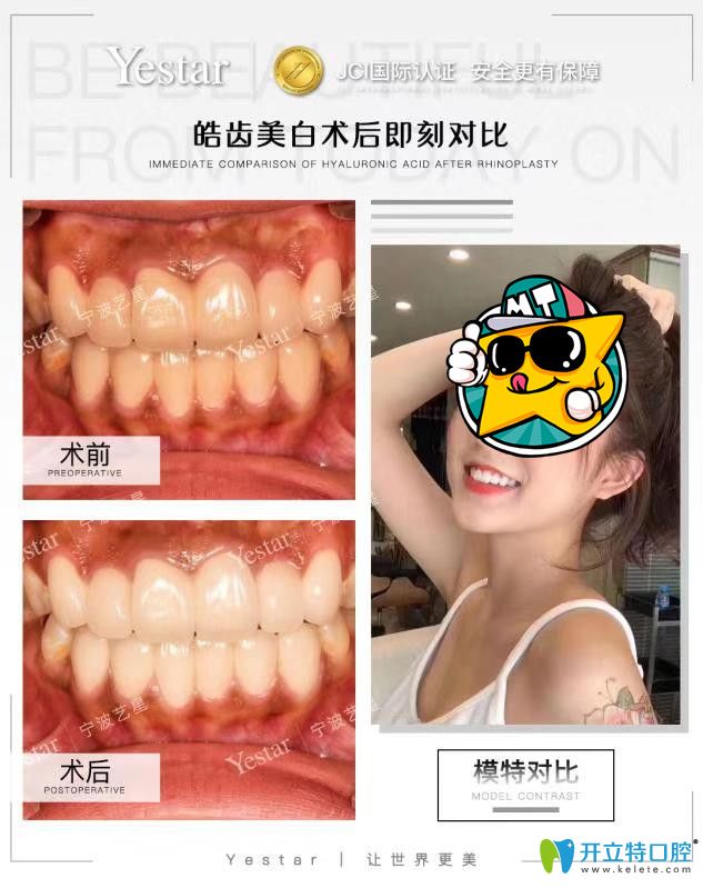 艺星口腔皓齿美白案例前后效果对比 艺星口腔皓齿美白案例前后效果对比